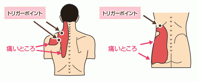 トリガーポイント