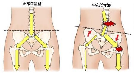 骨盤のゆがみ