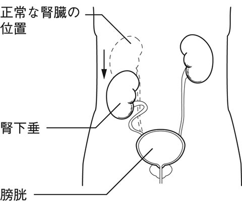 遊走腎