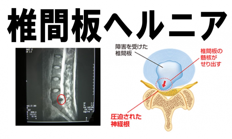 椎間板ヘルニア