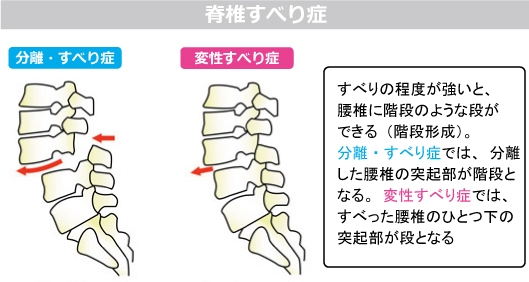 すべり症